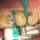 Sure Band Premolar 6.5mm - 50 Pack