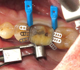 Sure Band Molar 5.5mm - 50 Pack